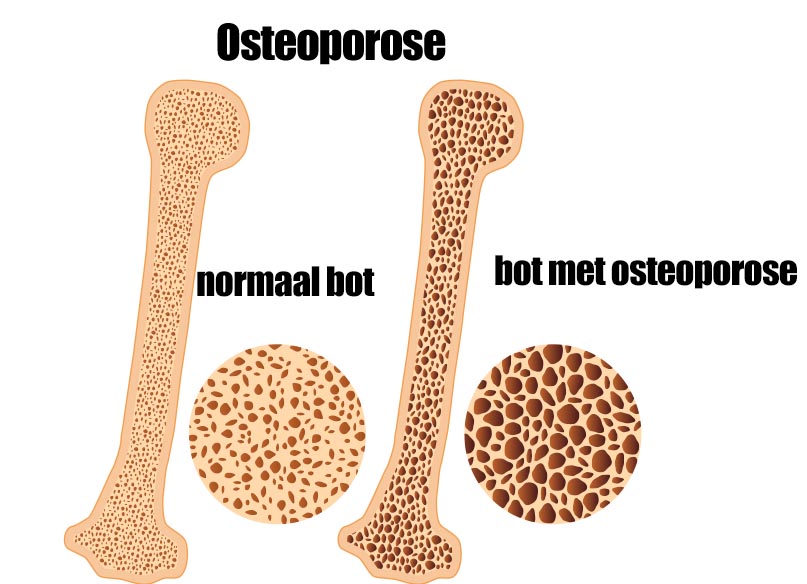 sterke botten osteoporose